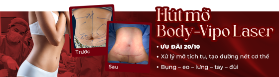 Hút mỡ S-LINE siết eo tạo hình bụng