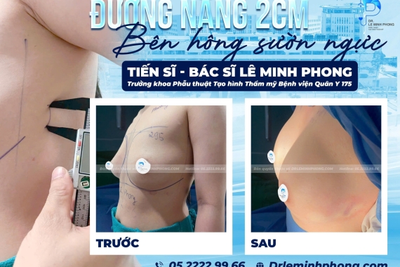 Quy trình nâng ngực đường bên hông sườn tại BV Quân Y 175 với TS.BS Lê Minh Phong