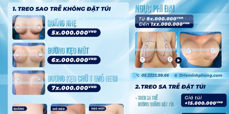 Bảng Giá Túi Ngực Treo Sa Trễ Mới Nhất 2026