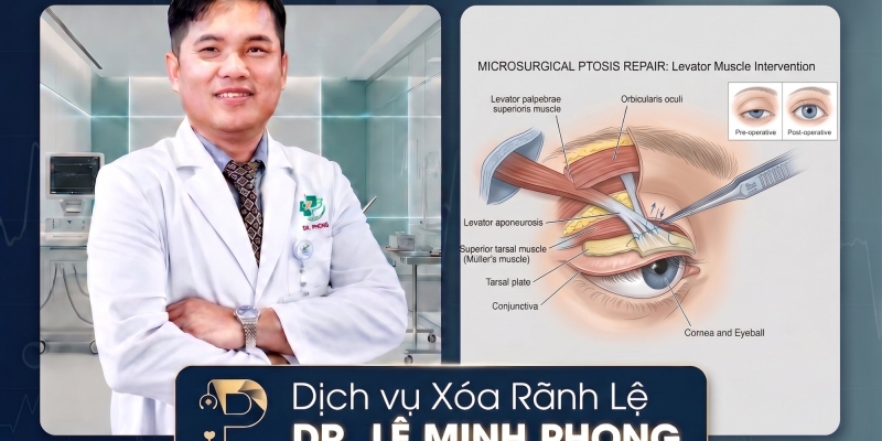 Xóa Rãnh Lệ