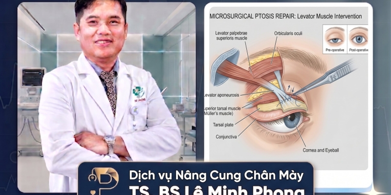 Chỉnh Sụp Mí Bẩm Sinh