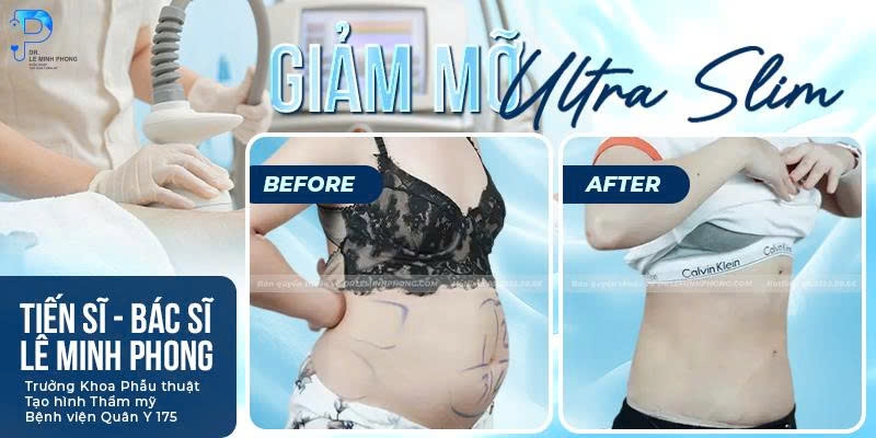 Giảm Mỡ ULtra Slim