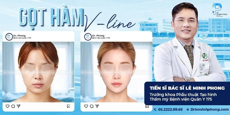 Gọt Hàm V-Line