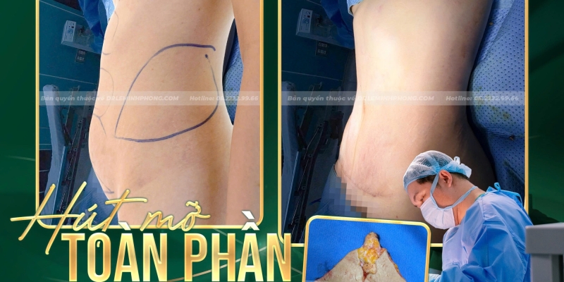 Hút Mỡ Bụng Toàn Phần