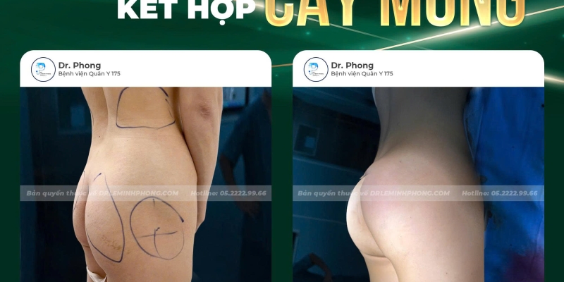 Hút mỡ kết hợp cấy mông