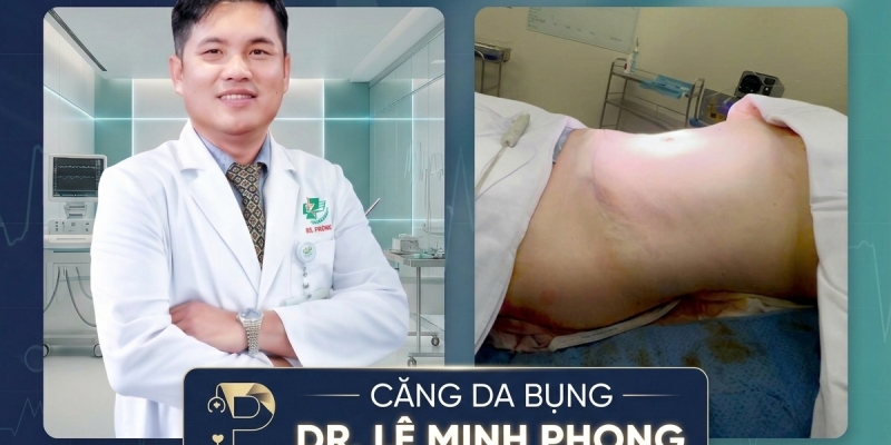 Căng Da Bụng