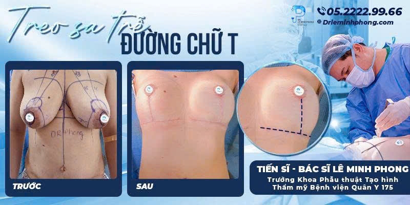 Treo ngực sa trễ đường chữ T