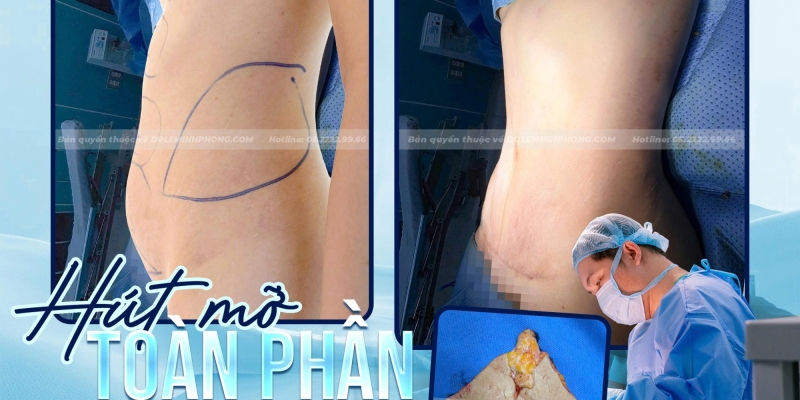 Hút Mỡ Toàn Phần An Toàn Tại BV 175