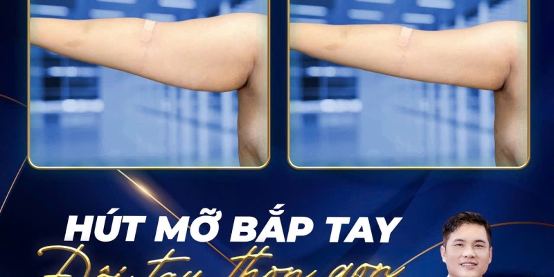Hút Mỡ Tay