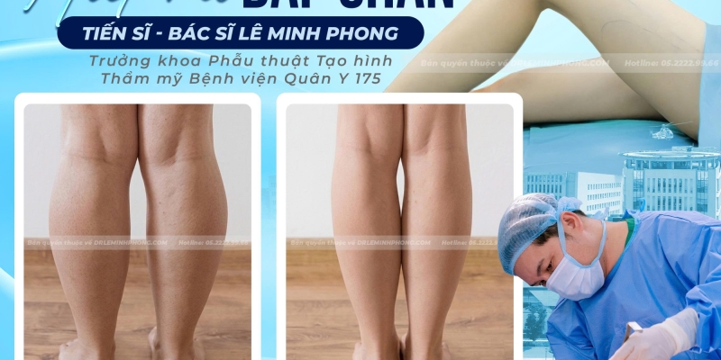 Hút Mỡ Bắp Chân