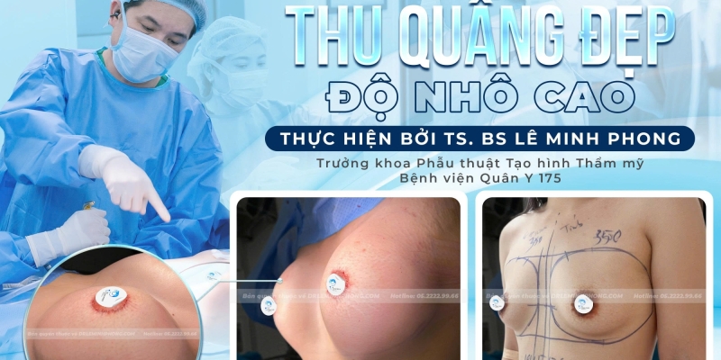 Thu Nhỏ Nhũ Hoa (Đầu Ti)