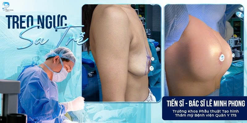Treo Ngực Sa Trễ