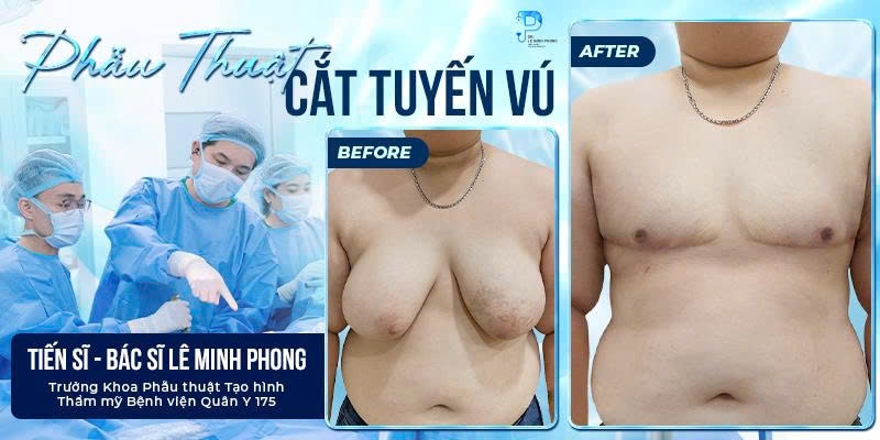 Cắt Tuyến Vú
