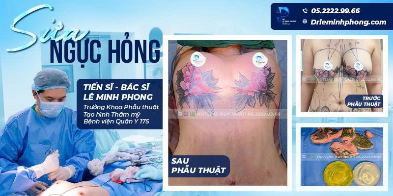 Sửa Ngực Hỏng