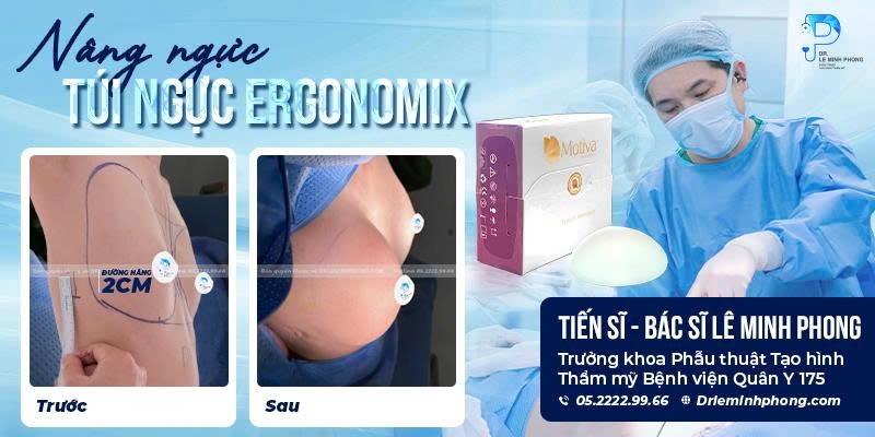 Nâng Ngực Ergonomix