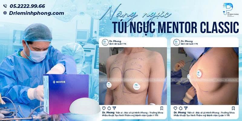 Nâng Ngực Mentor Thường