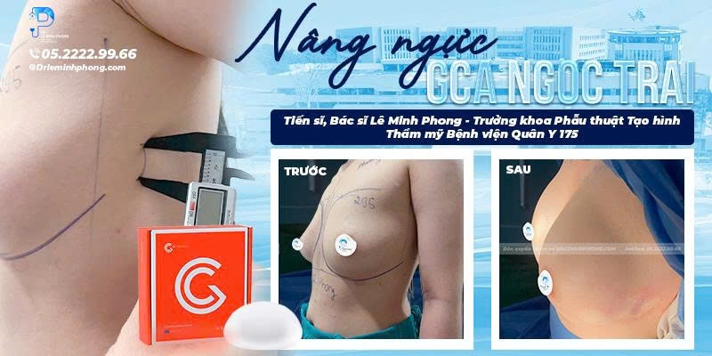 Nâng Ngực GCA Ngọc Trai