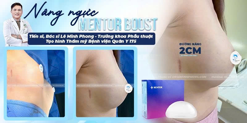 Nâng Ngực Mentor Boots