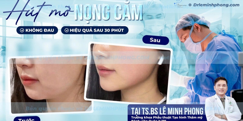Hút Mỡ Nọng Cằm