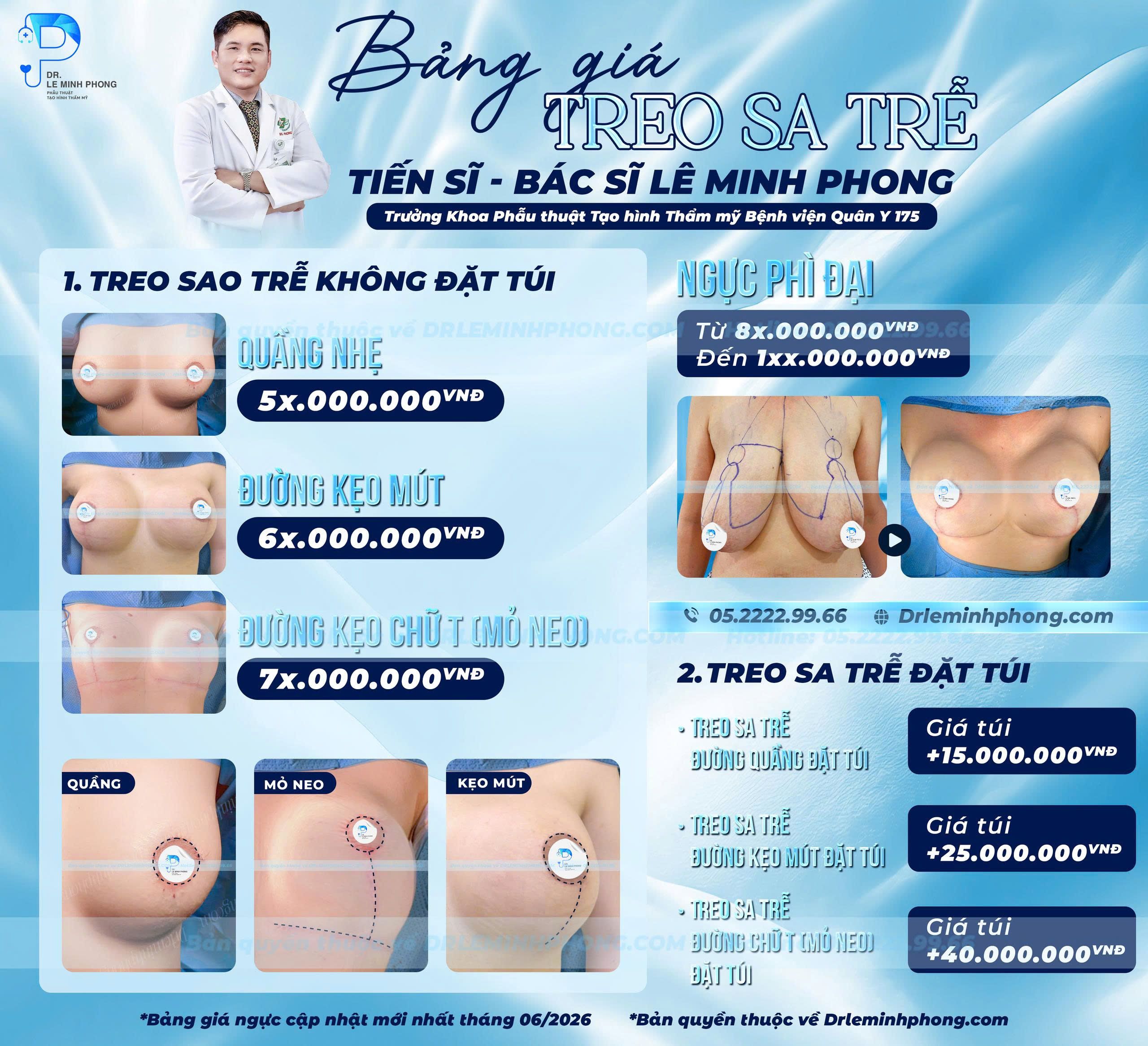 Bang-gia-tui-nguc-treo-sa-tre-cap-nhat-moi-nhat-2026