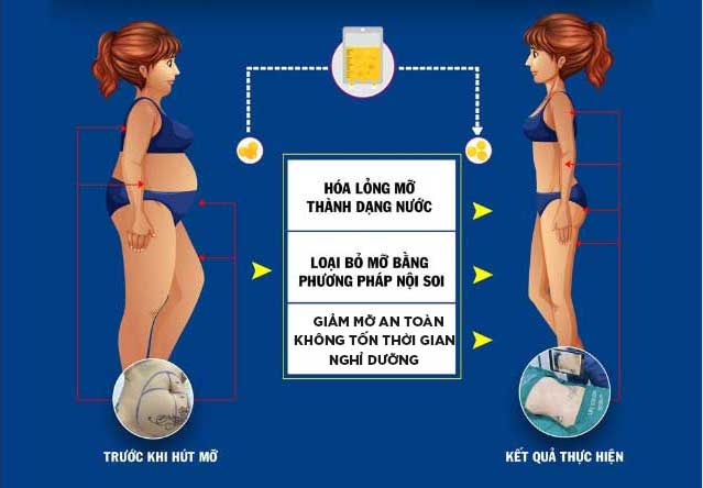 Bảng đồ họa so sánh trực quan các tiêu chí hiệu quả giữa giảm mỡ nội khoa và hút mỡ siêu âm Lipo Ultrasound
