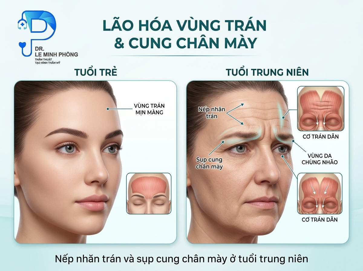 Tình trạng nếp nhăn hằn sâu vùng trán và sụp cung chân mày ở tuổi trung niên