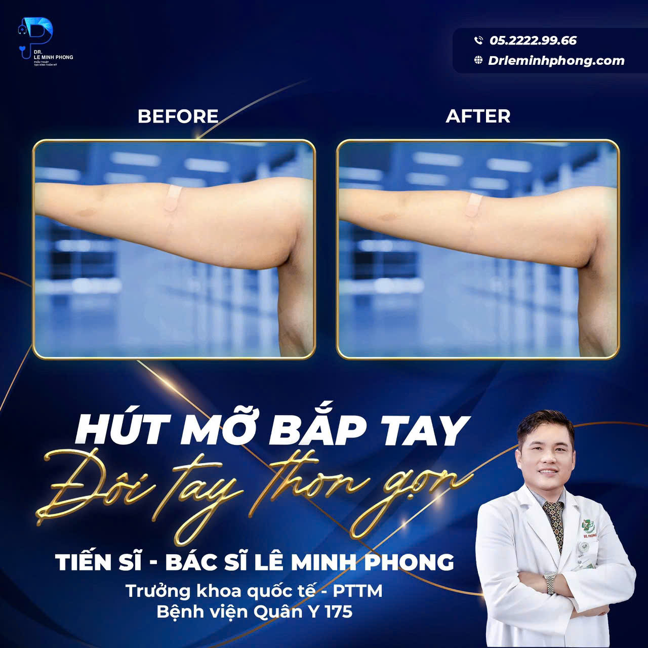 hut-mo-bap-tay-tai-dr-le-minh-phong