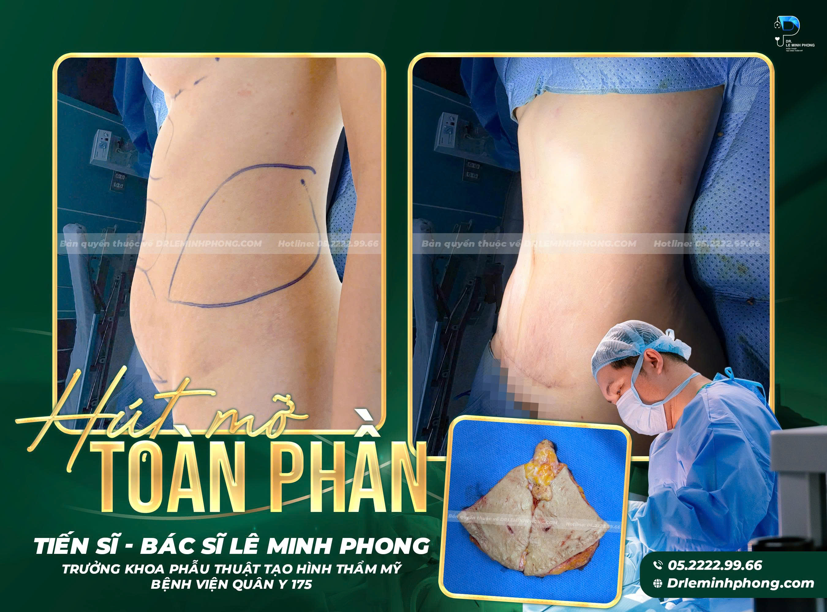 hut-mo-bung-toan-phan