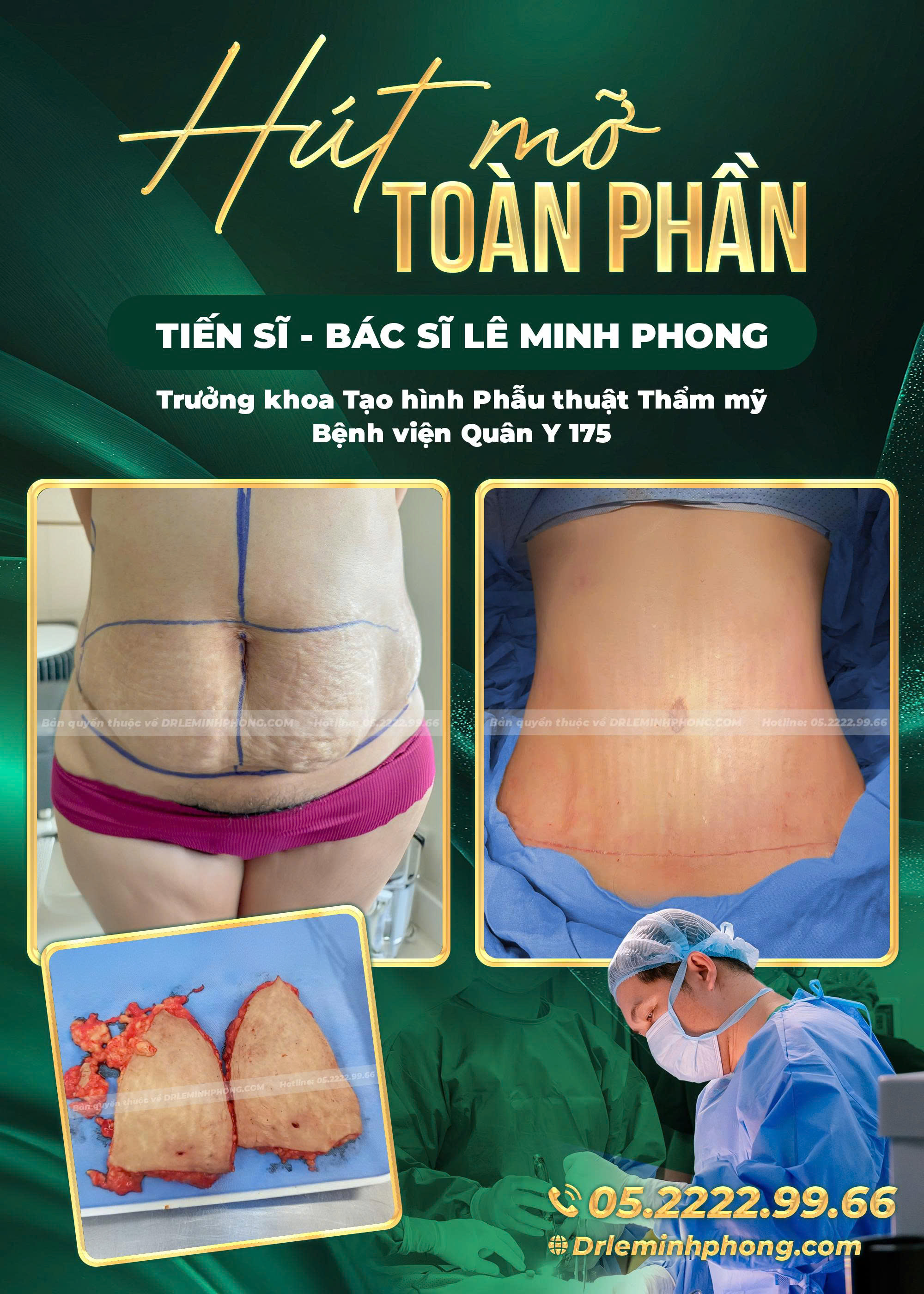 hut-mo-toan-phan-dr-le-minh-phong