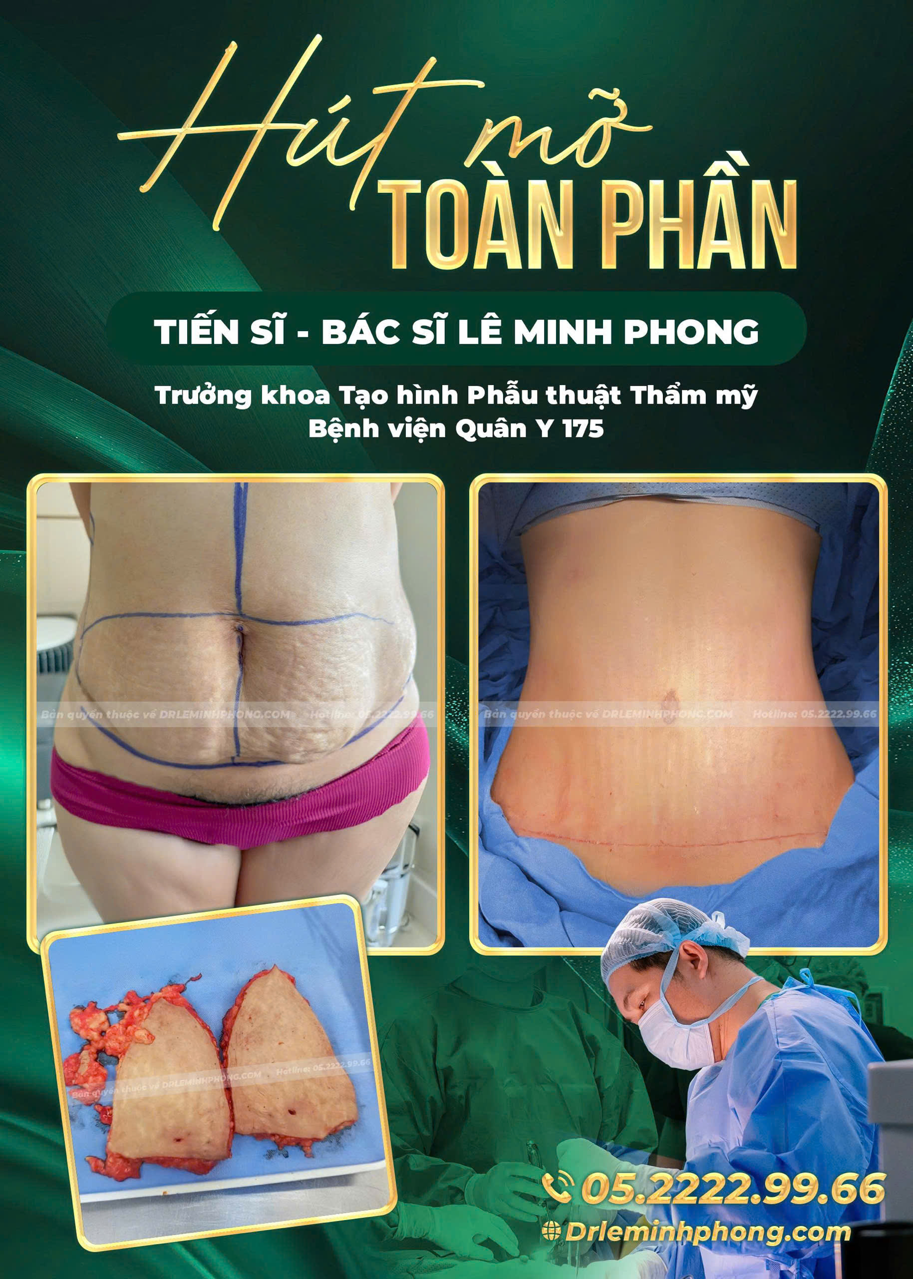 hut-mo-toan-phan