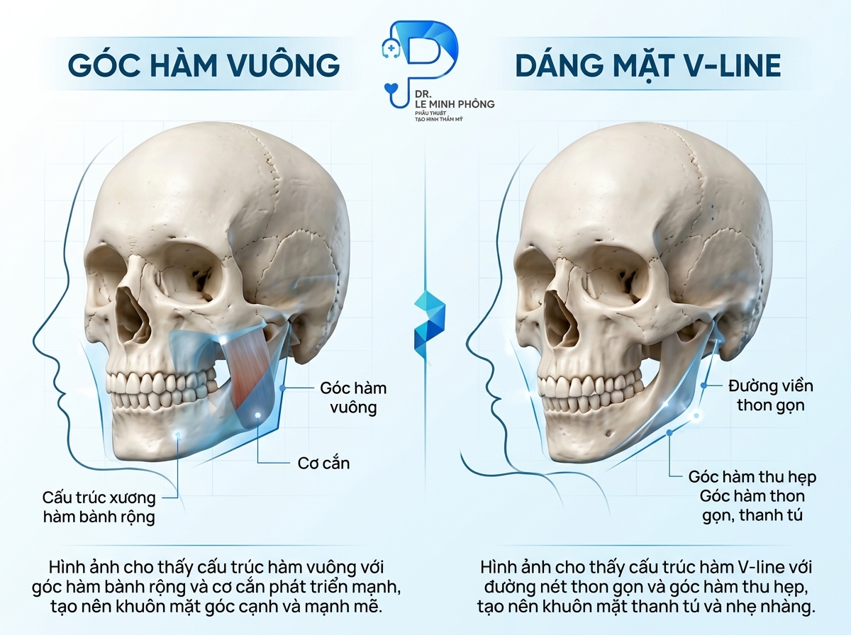 Sự khác biệt giữa hệ khung xương mặt vuông bạnh và dáng mặt V-line thanh tú