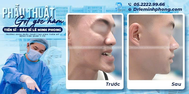 Gương mặt thon gọn mềm mại quý phái sau khi phẫu thuật gọt góc hàm