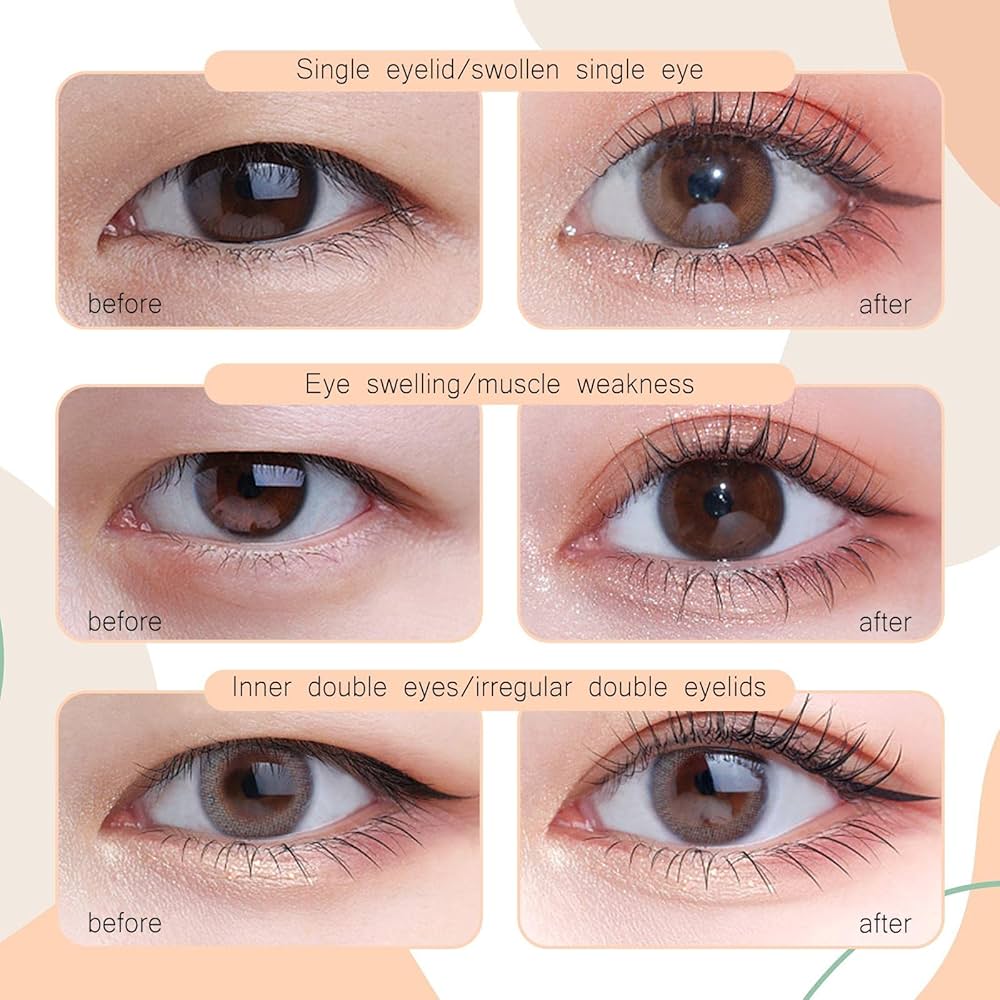 Kỹ thuật cắt mí Eyelid vi phẫu ít xâm lấn
