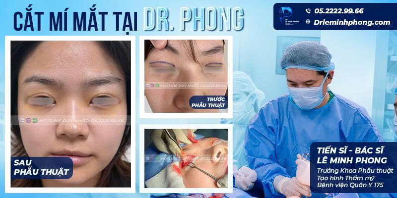 TS.BS Lê Minh Phong đang tỉ mỉ bóc tách mô sẹo, sửa mí hỏng cho khách hàng tại phòng mổ