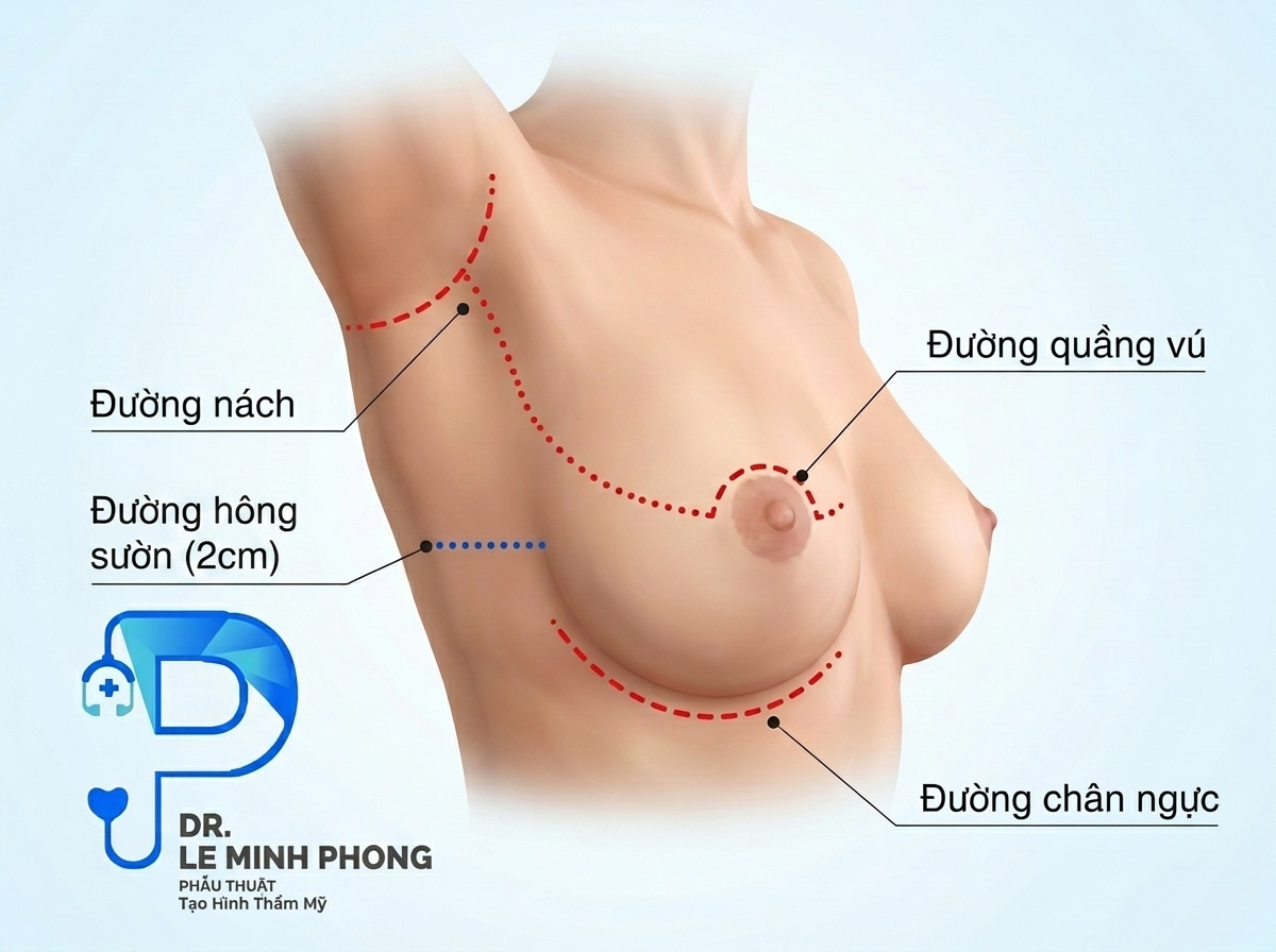 so sánh đường nâng ngực đường mổ 2cm an toàn