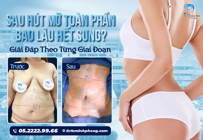 Tình trạng sưng nề sau hút mỡ toàn phần là phản ứng sinh lý phục hồi tự nhiên của mô mềm