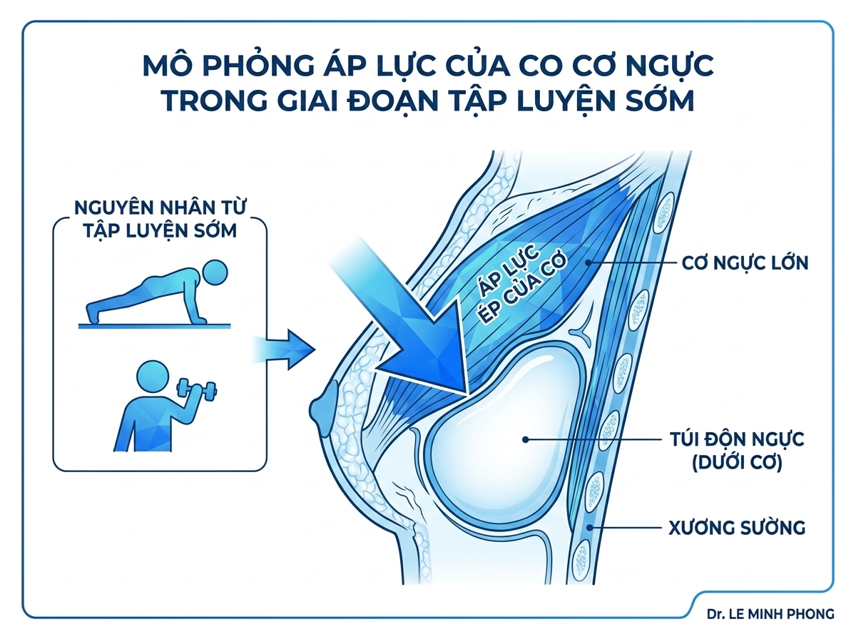 Đồ họa cơ chế co thắt của cơ ngực tỳ đè lên vị trí đặt túi ngực