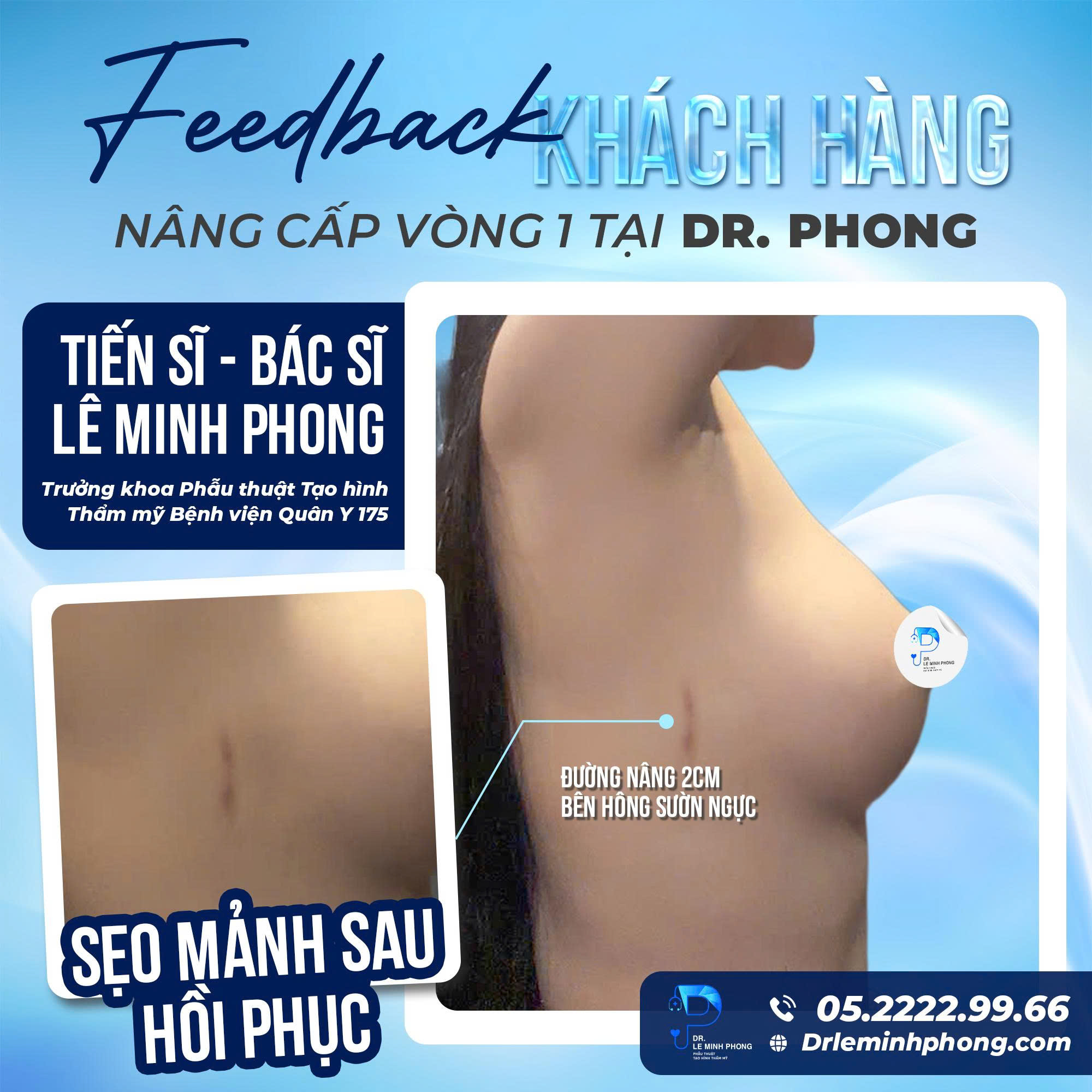 Kết quả dáng ngực mềm mại tự nhiên sau khi nâng ngực nội soi
