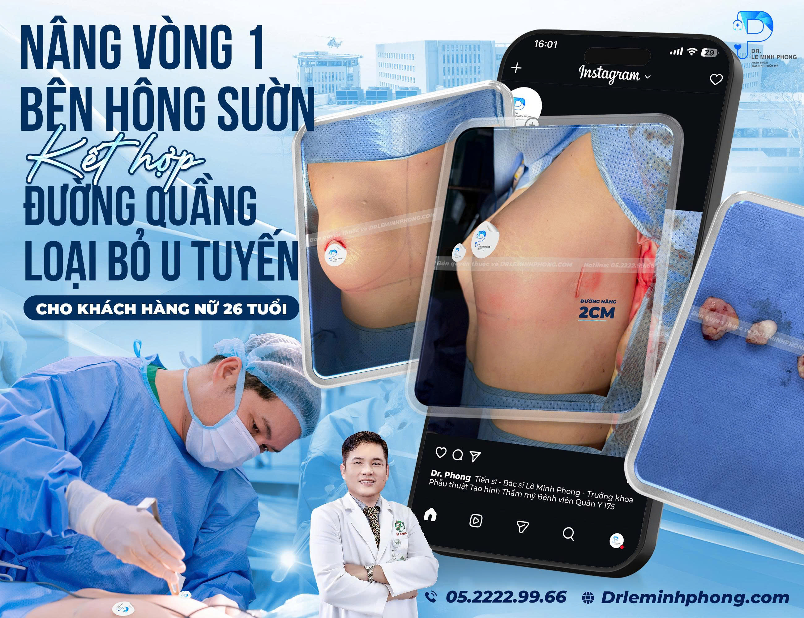 nang-vong-1-ben-hong-suon-ket-hop-duong-quang-loai-bo-u-tuyen