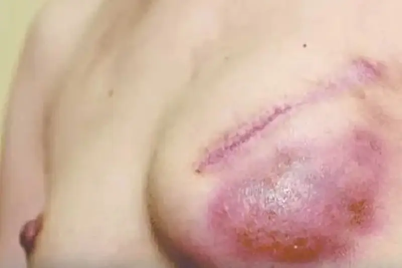 bien chung nang nguc tai spa