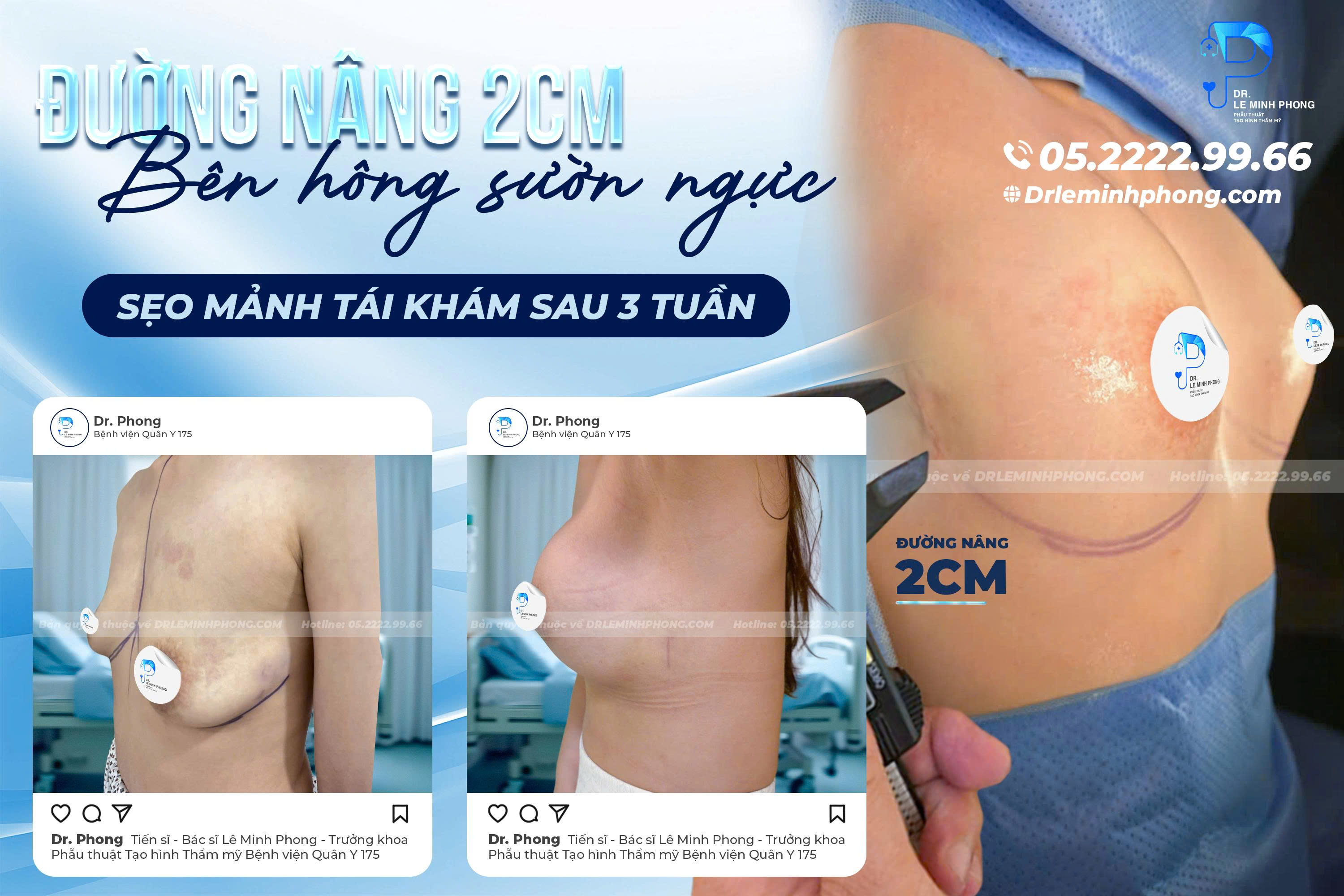 Nhờ kỹ thuật nâng ngực phục hồi nhanh, khách hàng giảm cảm giác ê buốt và có thể sinh hoạt bình thường sớm
