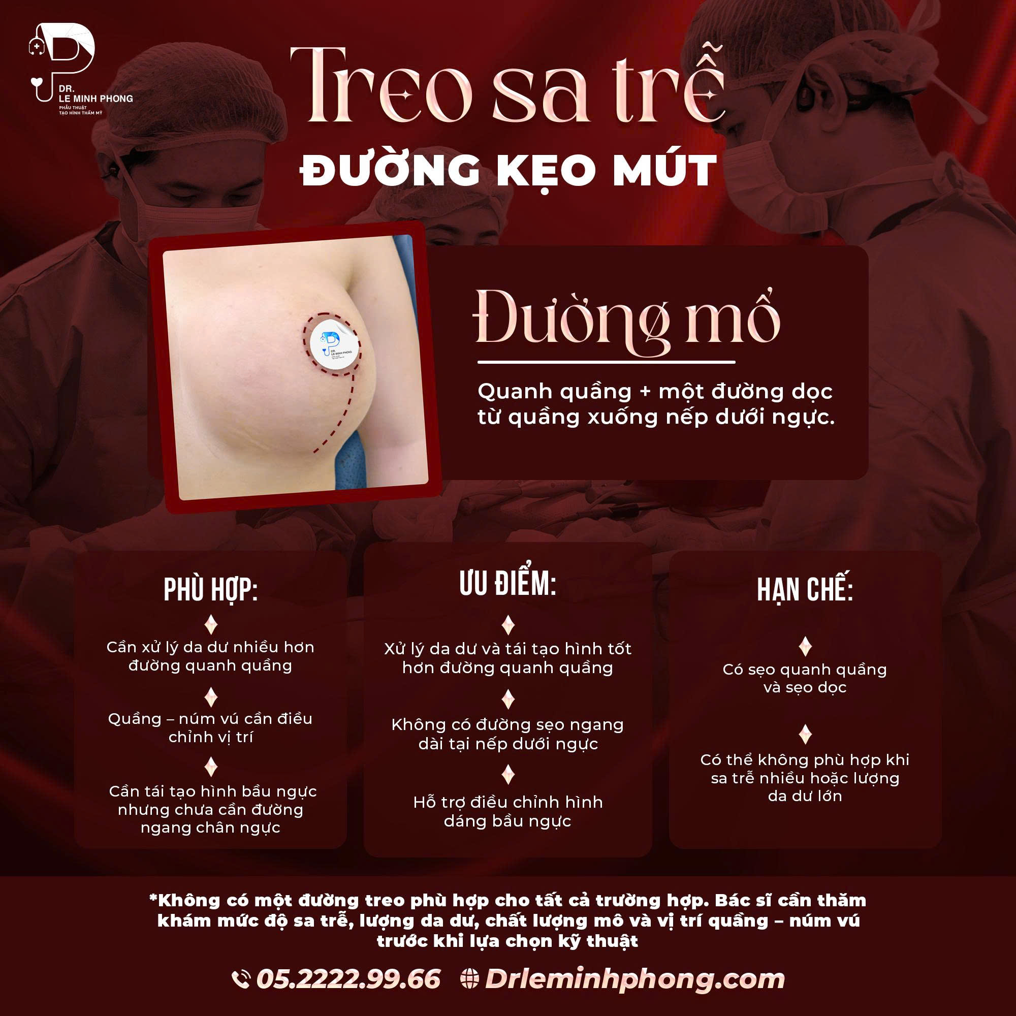 treo-sa-tre-duong-keo-mut