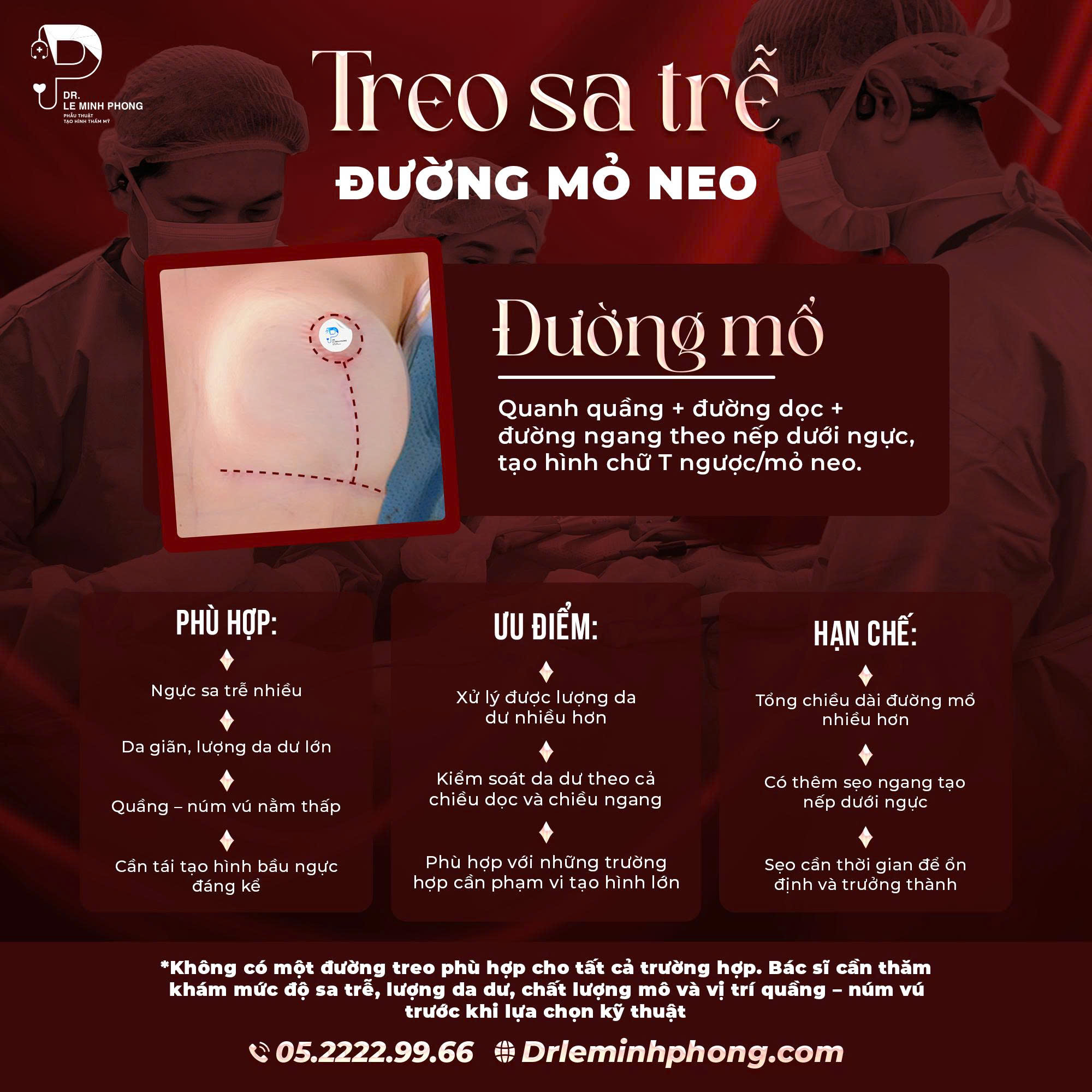 treo-sa-tre-duong-mo-neo