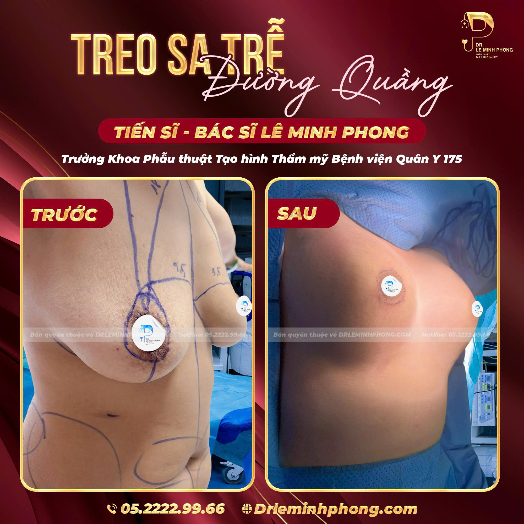 Treo Sa Trễ Đường Quầng – Khôi Phục Vòng 1 Căng Tròn Tự Nhiên
