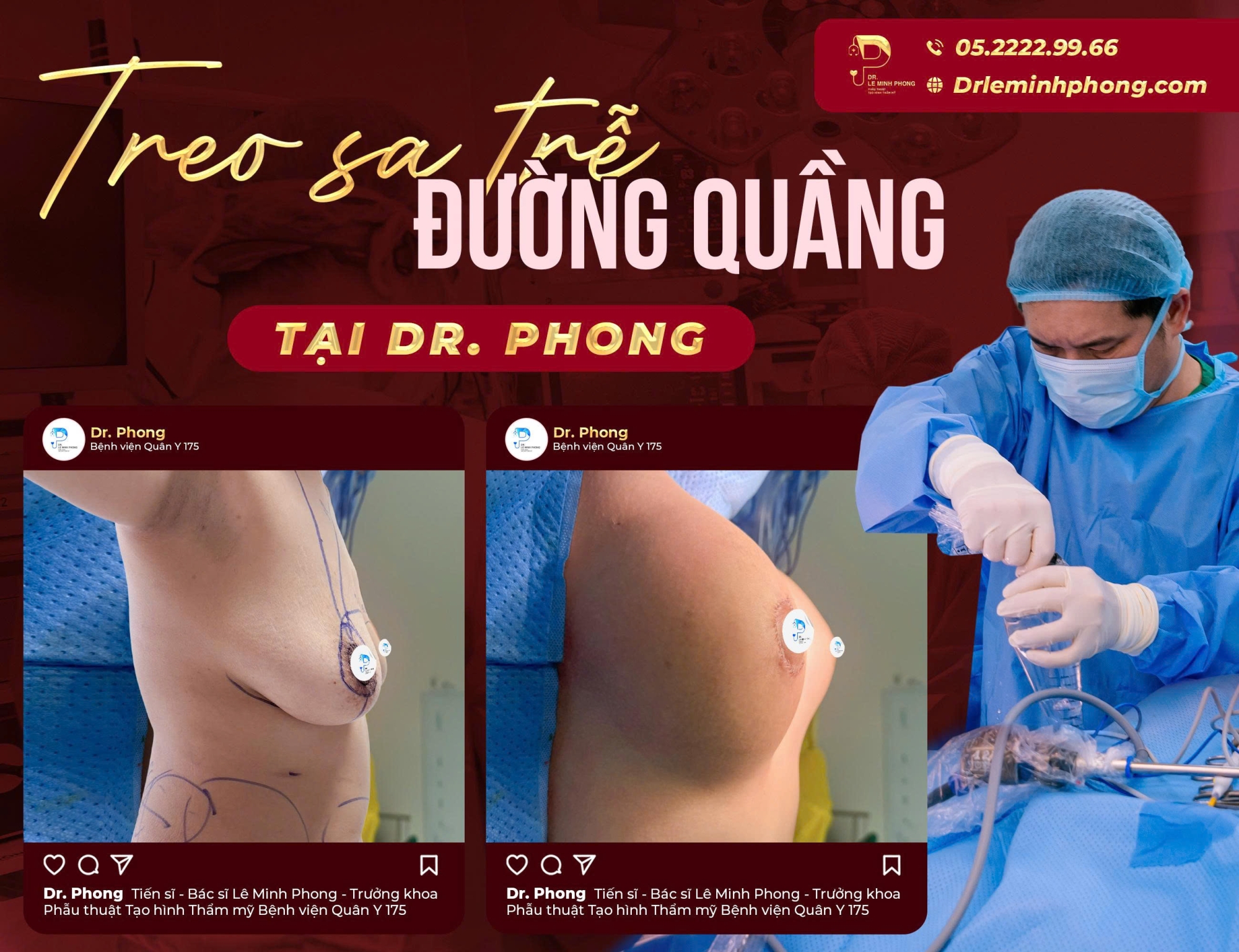 Treo Sa Trễ Đường Quầng Thực Hiện Bởi TS.BS Lê Minh Phong
