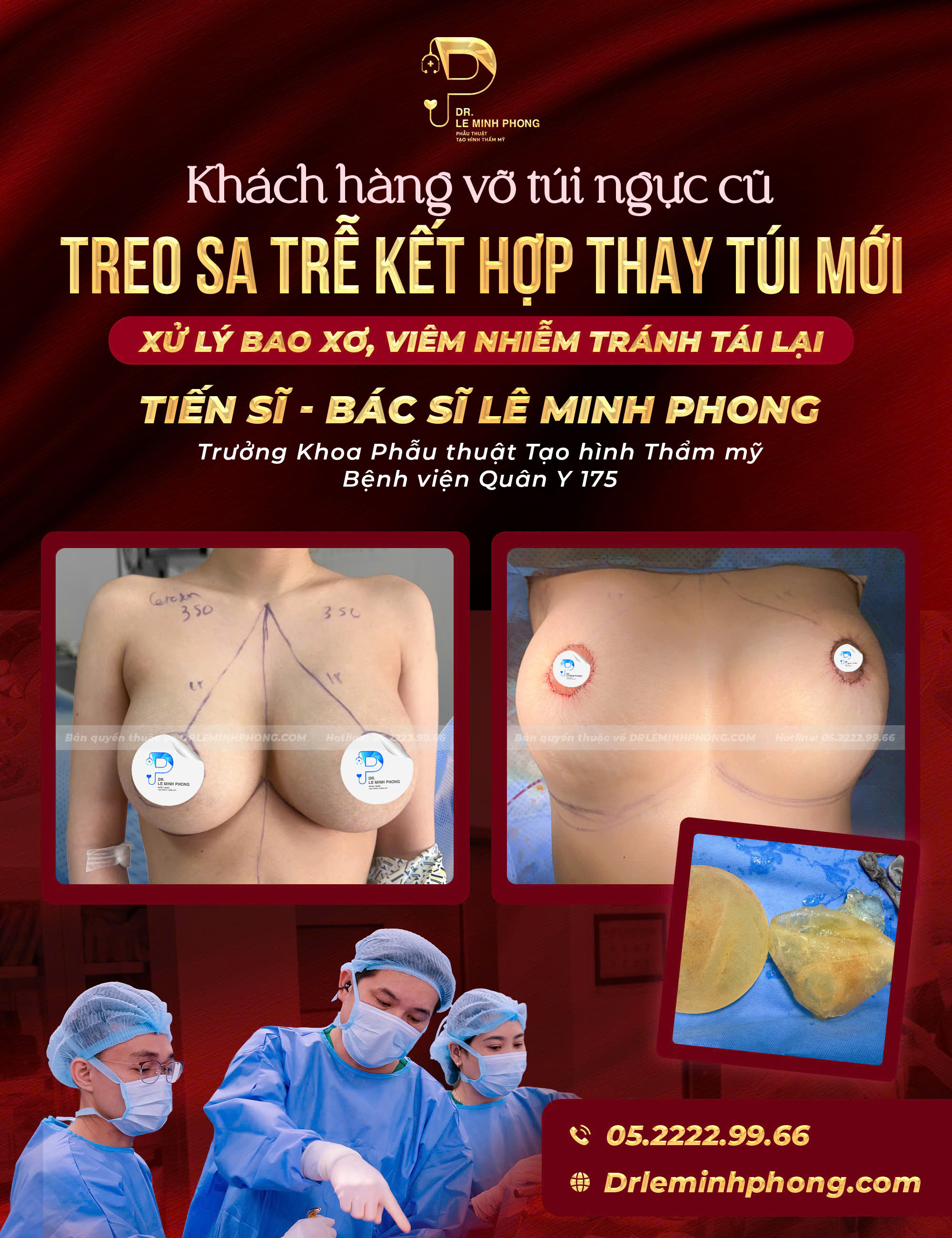 Treo Sa Trễ Kết Hợp Thay Túi Mới - Xử Lý Bao Xơ