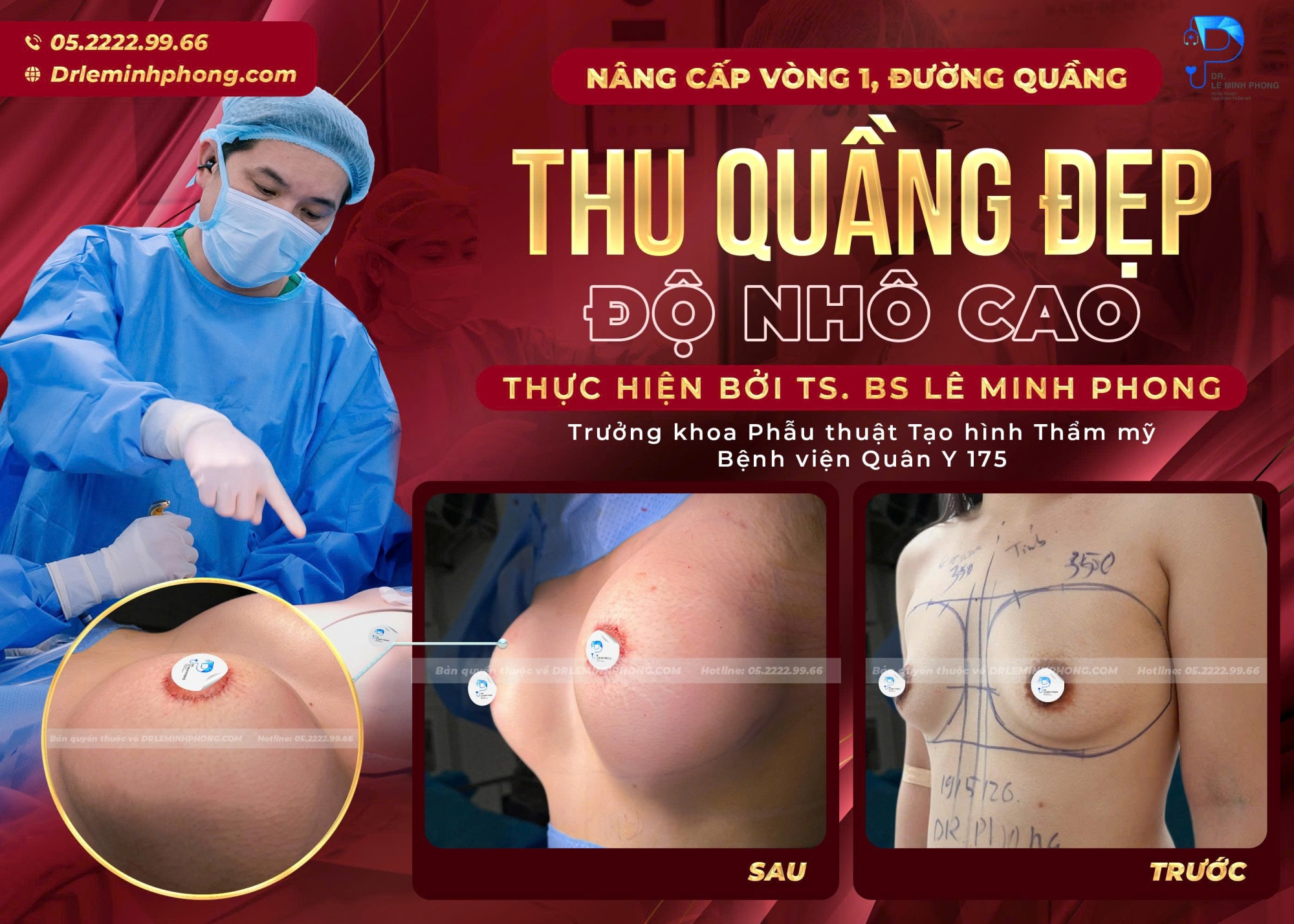 Treo Sa Trễ Đường Quầng Mang Lại Vòng 1 Săn Chắc Hài Hòa