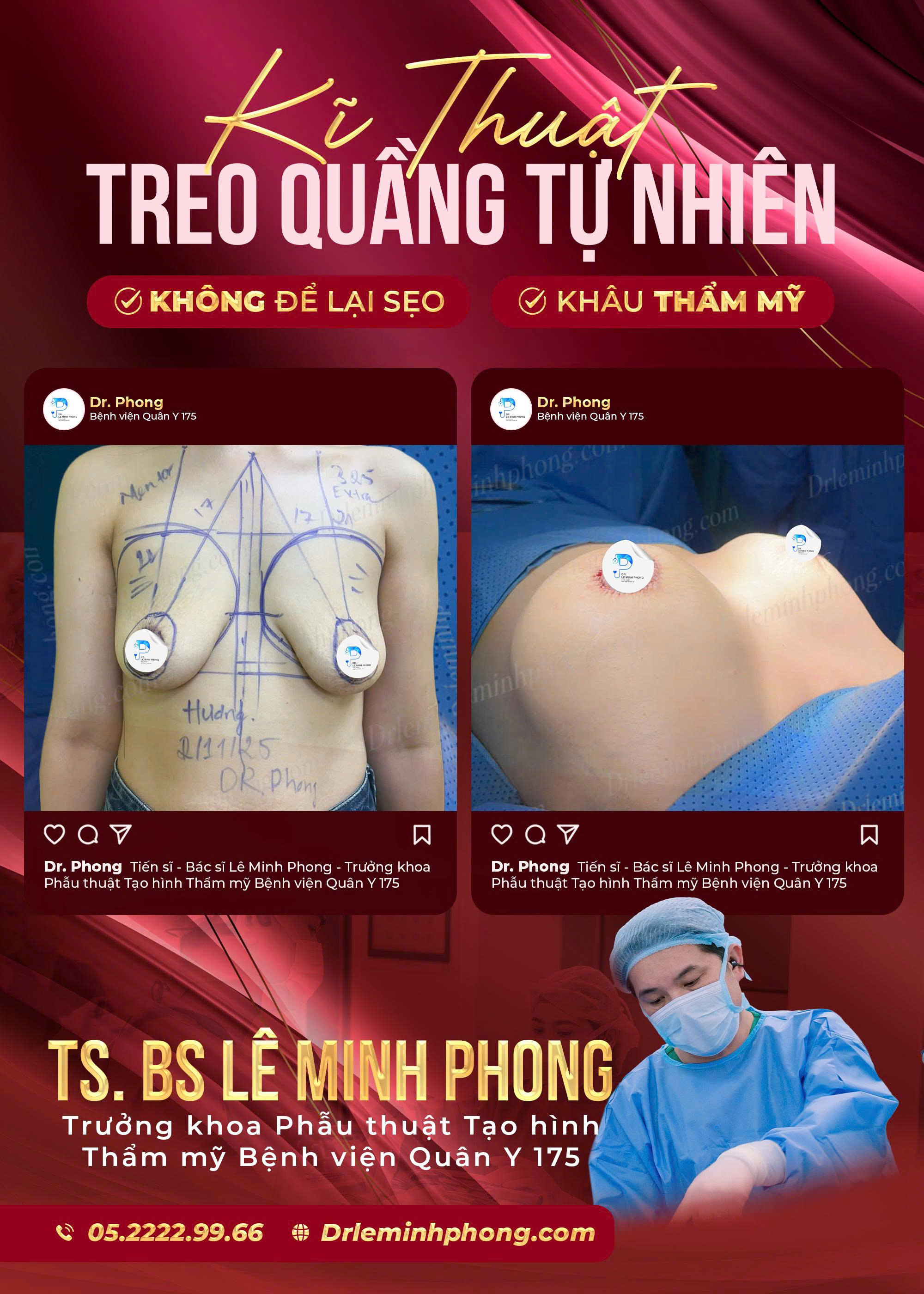 Treo Sa Trễ Đường Quầng Khắc Phục Tình Trạng Ngực Chảy Xệ