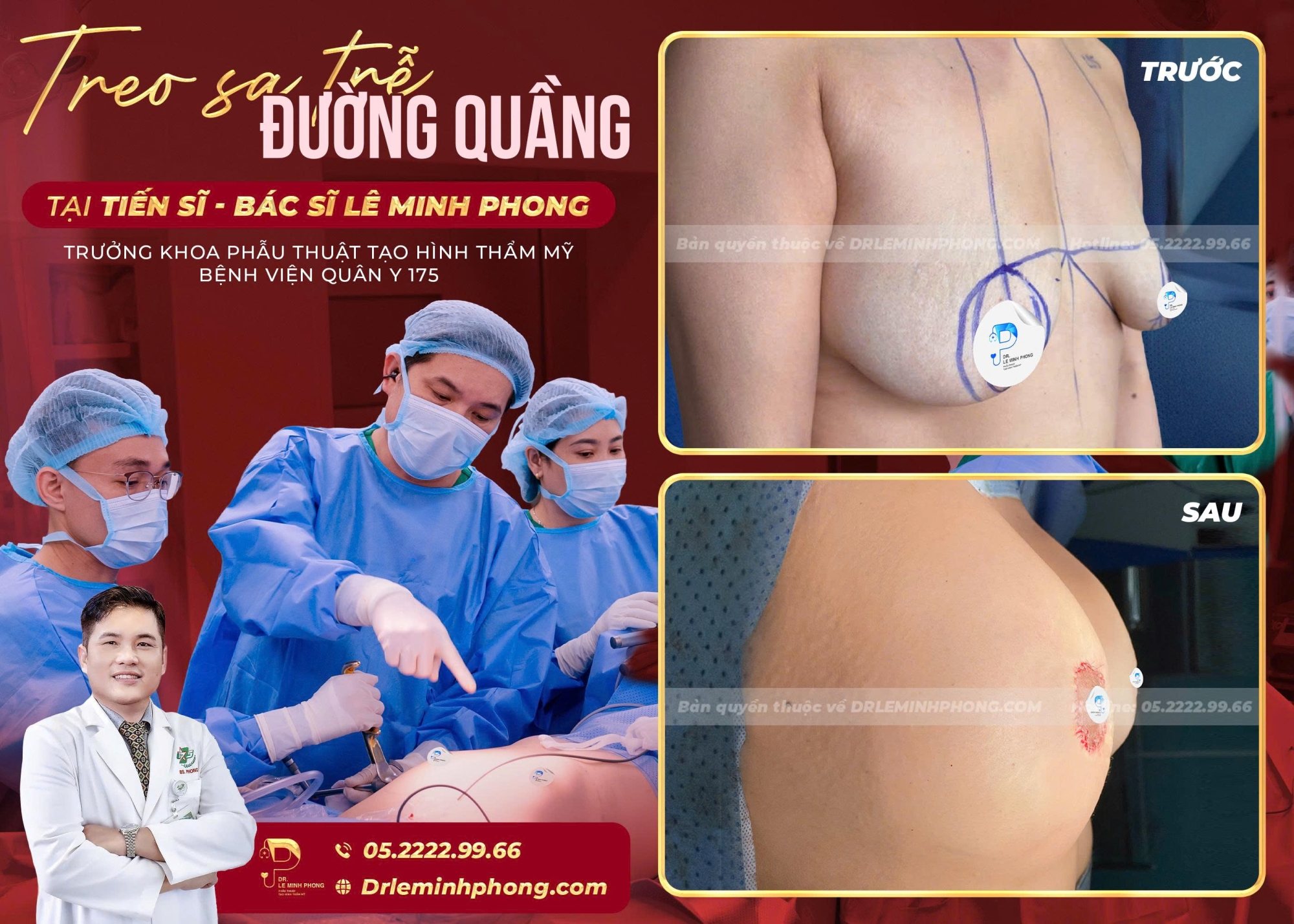 Treo Sa Trễ Đường Quầng – Giữ Trọn Cảm Giác Đầu Ngực