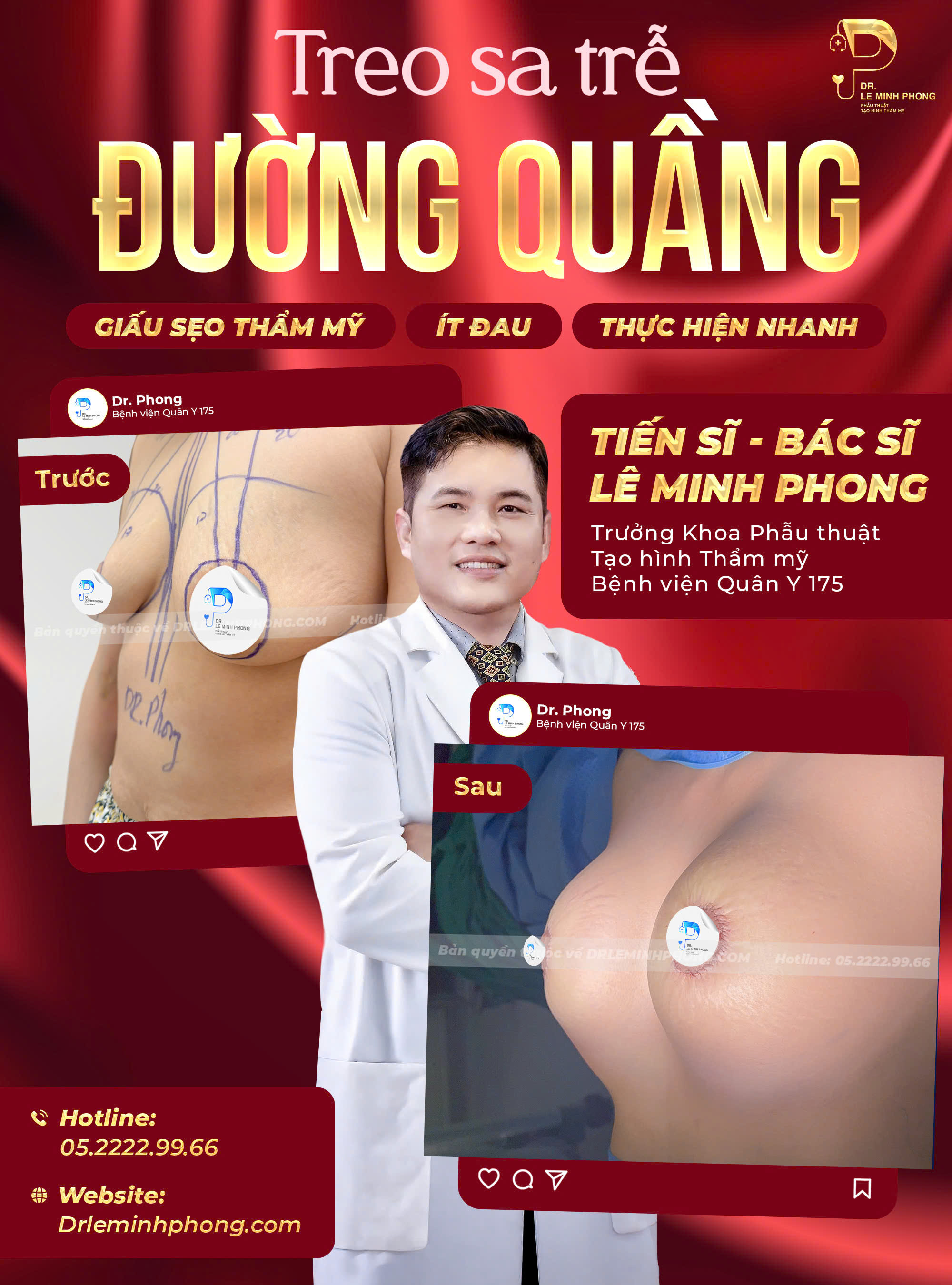 Treo Sa Trễ Đường Quầng Định Hình Vòng 1 Căng Tròn